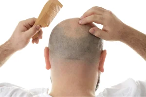 درمان خانگی ریزش موی سر